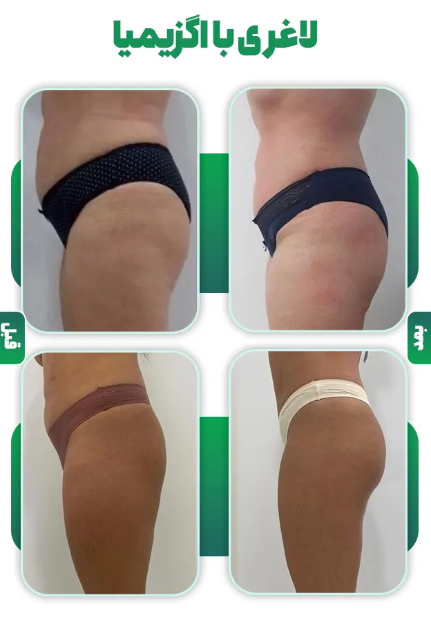 قبل و بعد لاغری با اگزیمیا