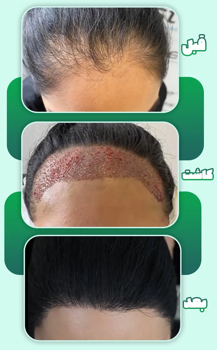 قبل و بعد کاشت مو زنان