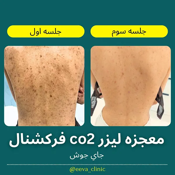 لیزر-جای-جوش