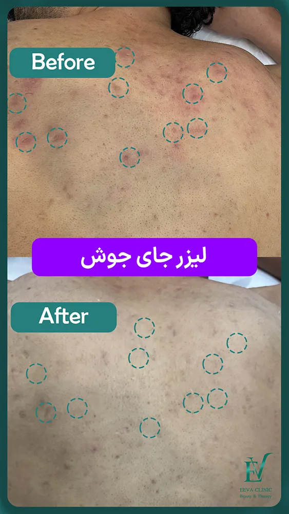 لیزر جای جوش