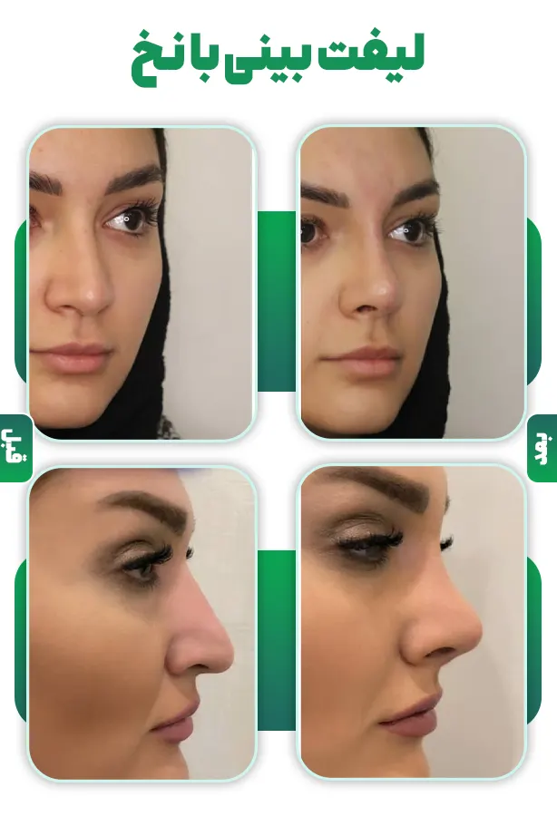 لیفت بینی با نخ