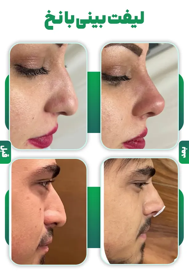 لیفت بینی با نخ