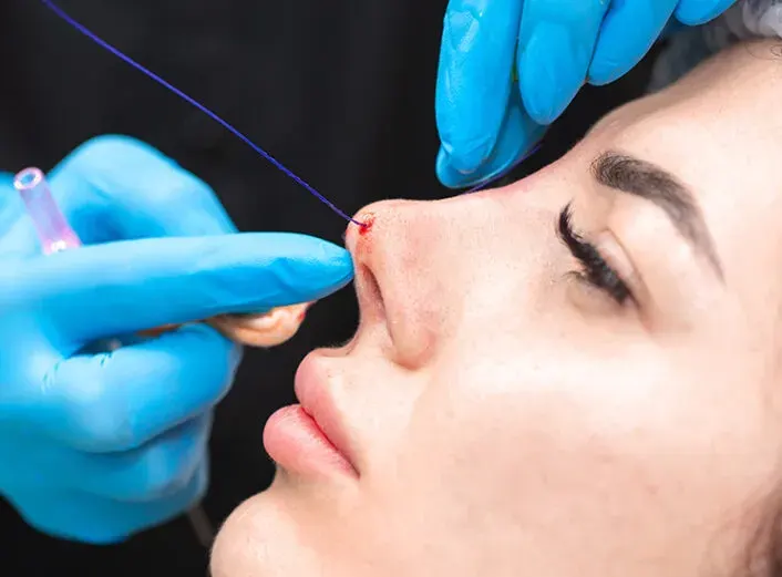 لیفت بینی با نخ