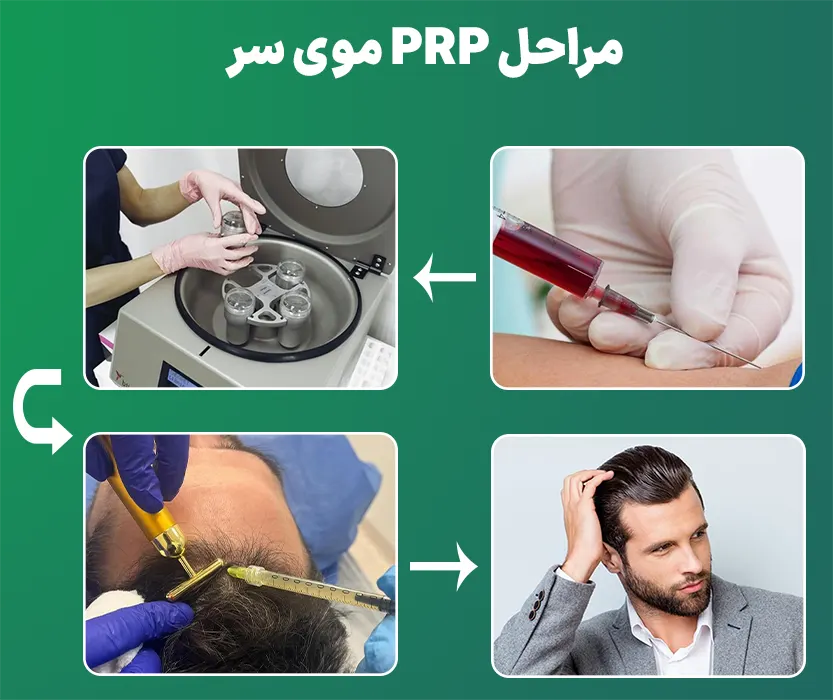 مراحل PRP موی سر