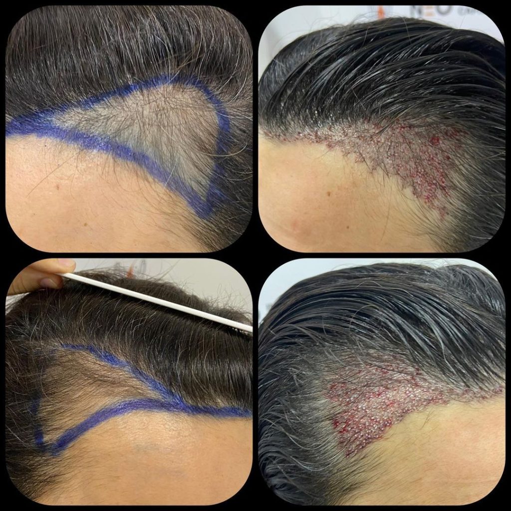 کاشت مو بانوان