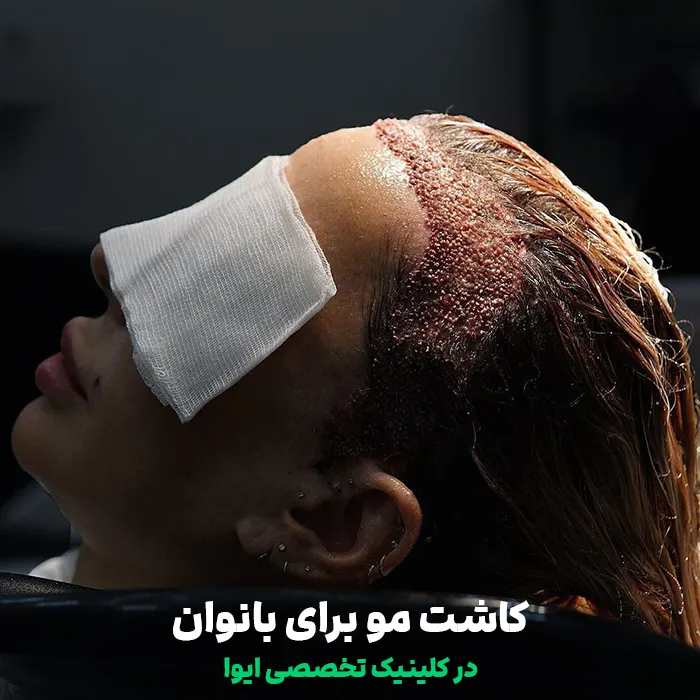 کاشت مو بانوان