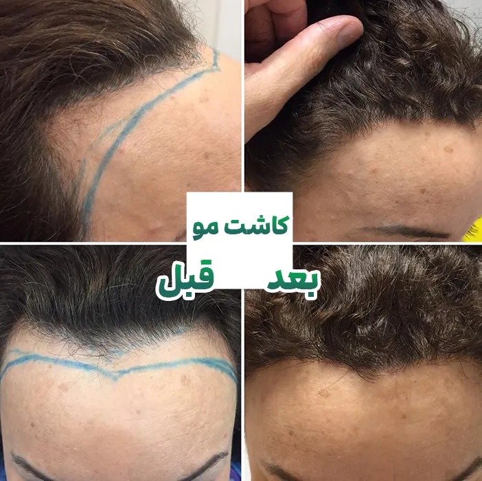قبل و بعد کاشت مو زنان