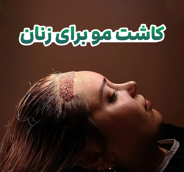 کاشت مو برای زنان