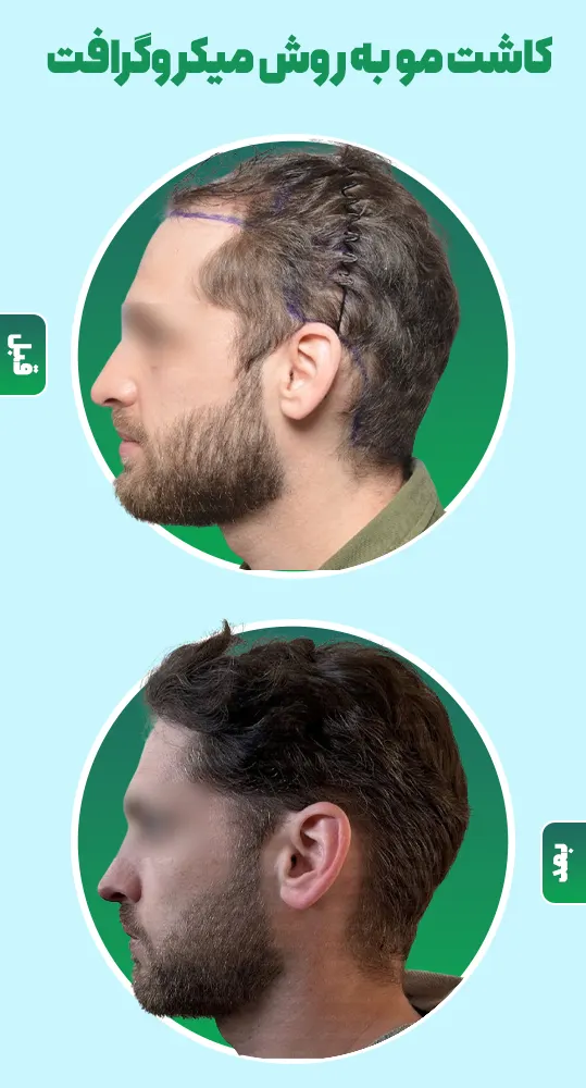 قبل و بعد کاشت مو