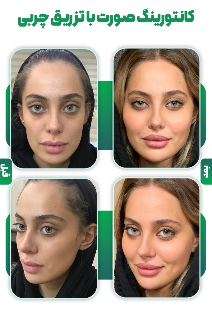 کانتورینگ صورت با تزریق چربی