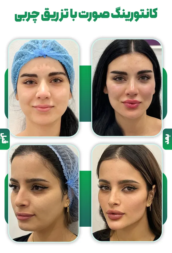 کانتورینگ صورت با تزریق چربی