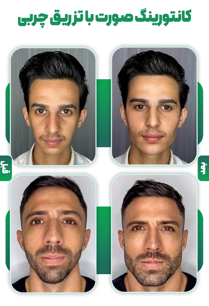 کانتورینگ صورت با تزریق چربی