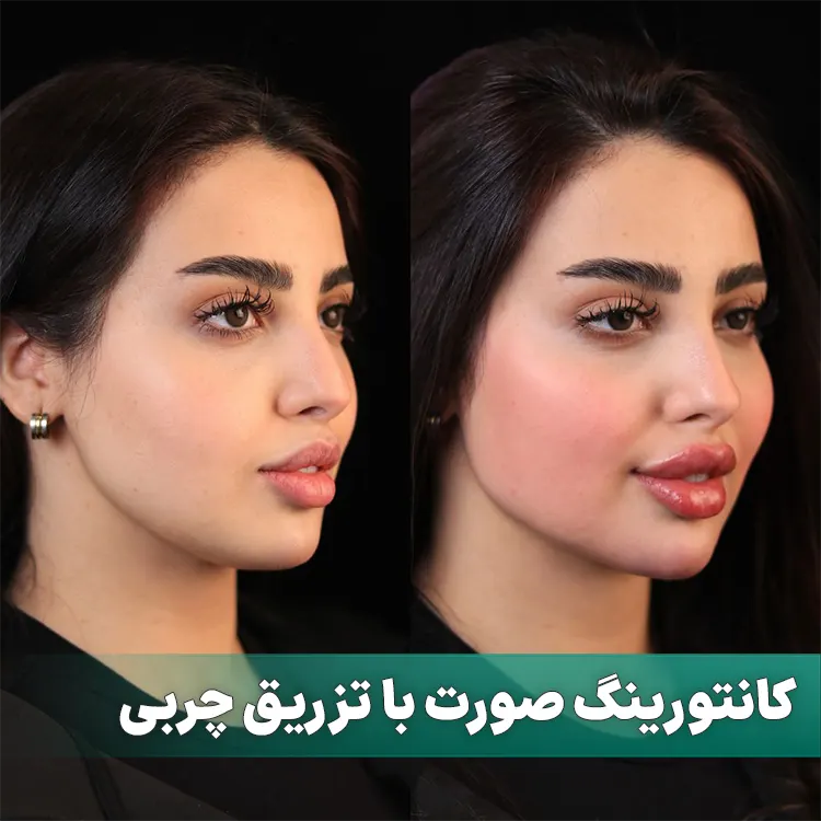 کانتورینگ صورت با تزریق چربی