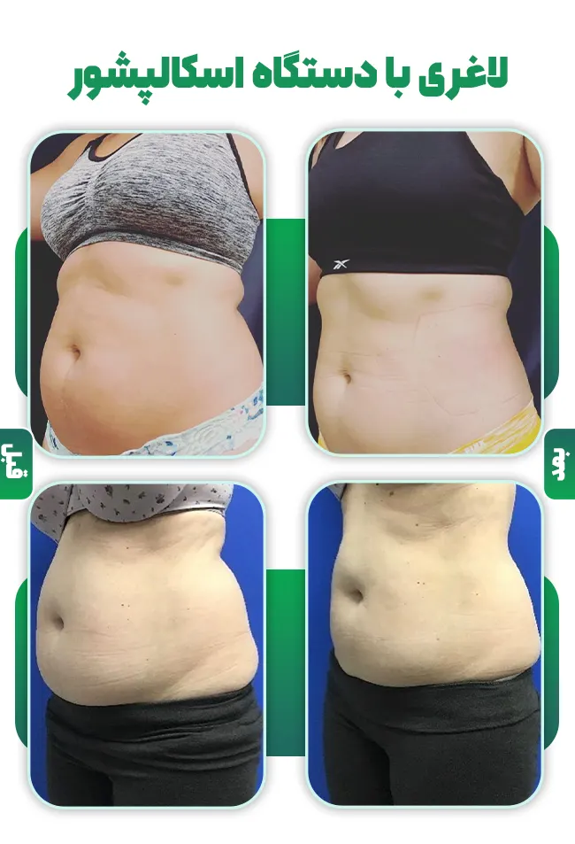 قبل و بعد لاغری با اسکالپشور