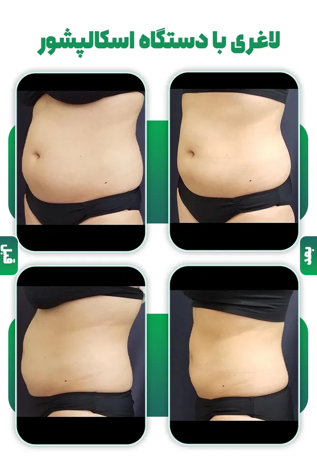 لاغری با اسکالپشور