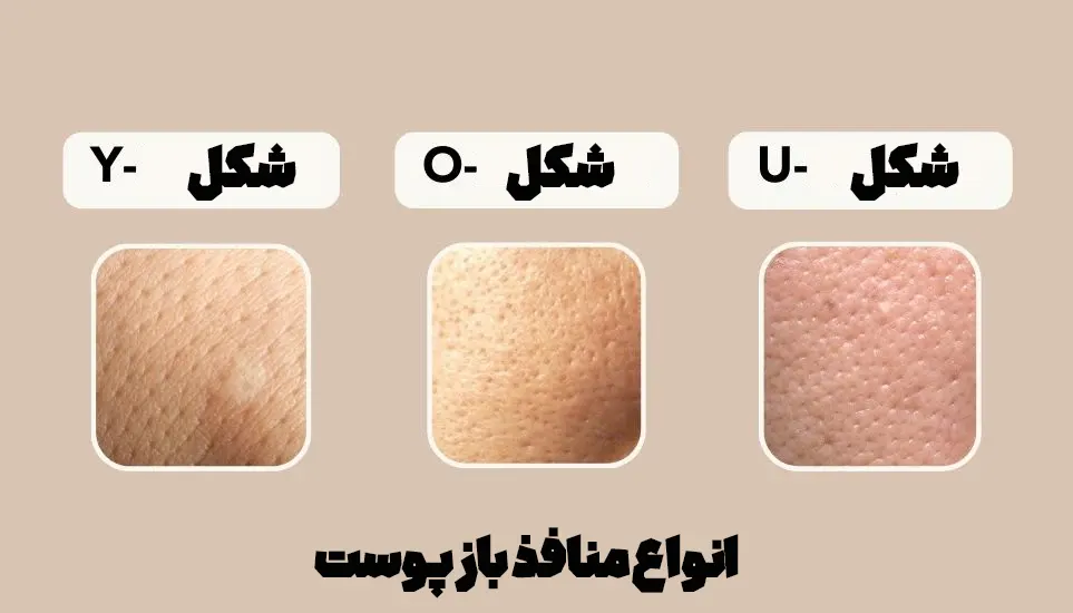 انواع منافذ باز پوست