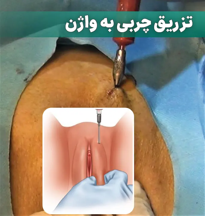 تزریق چربی به واژن