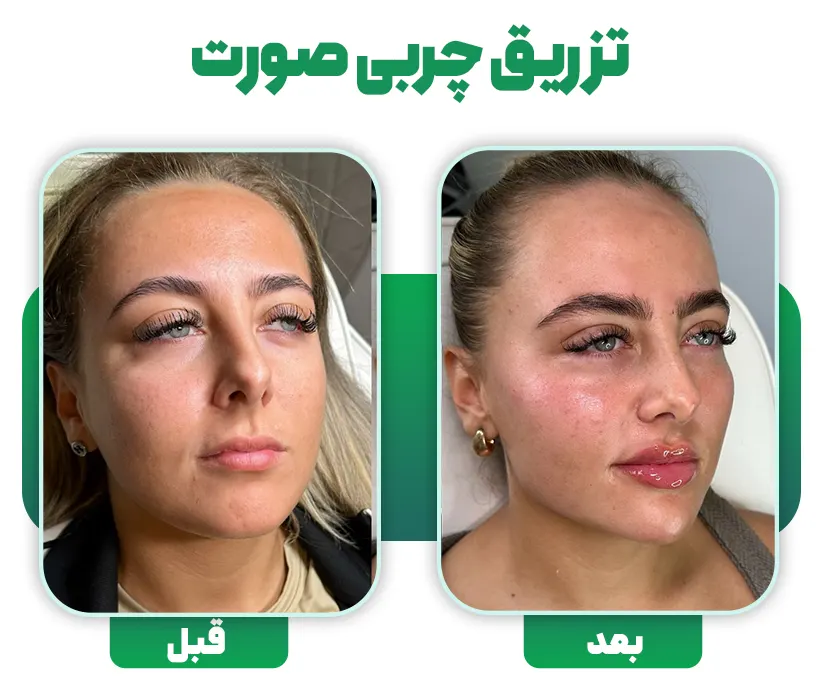 تزریق چربی صورت