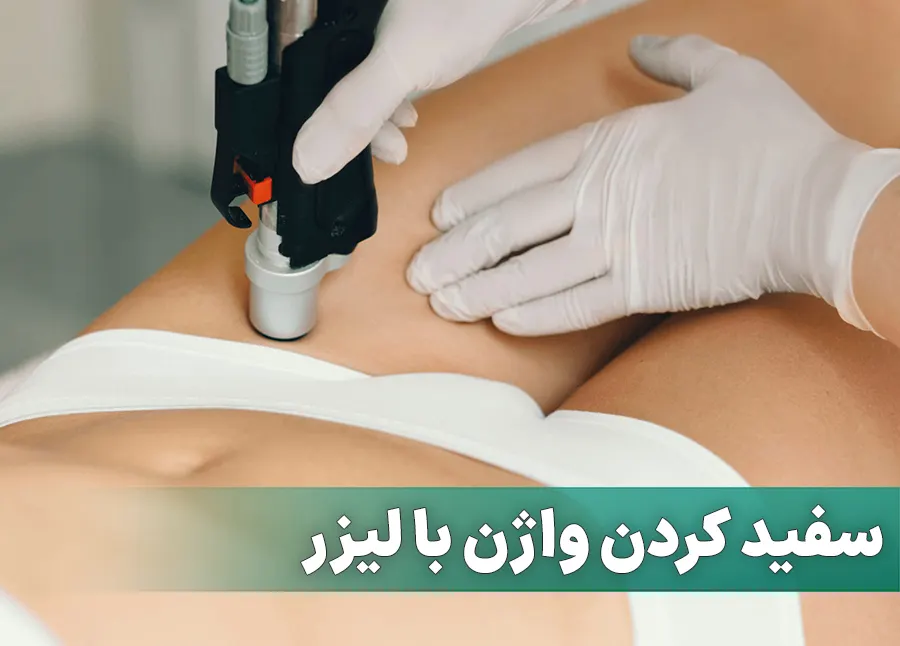 سفید کردن واژن با لیزر