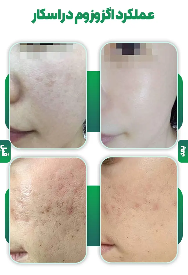 عملکرد اگزوزوم در اسکار