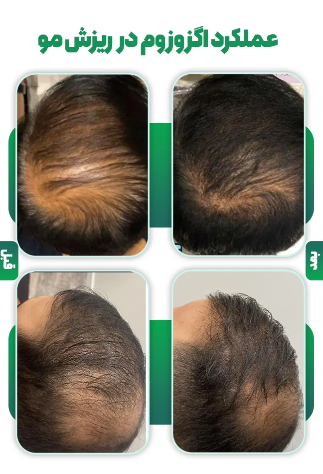 عملکرد اگزوزوم در ریزش مو
