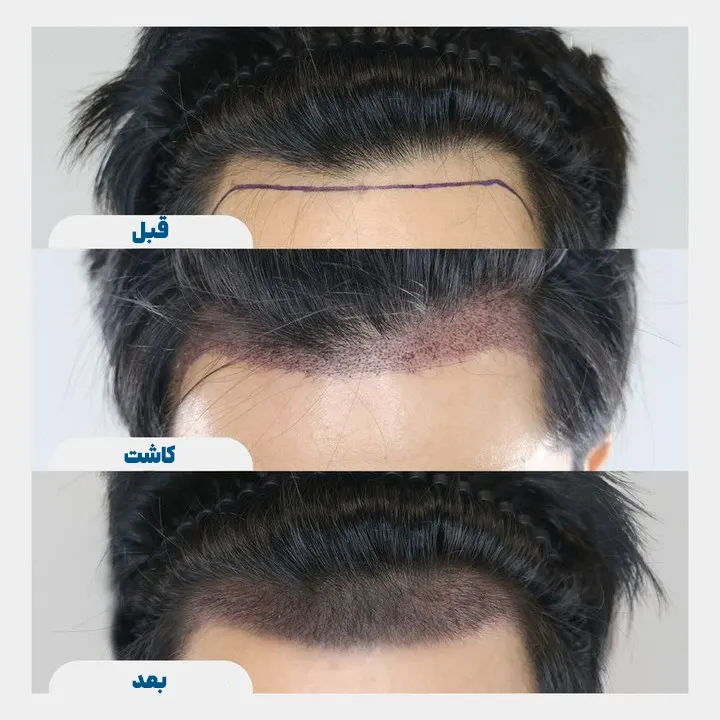 قبل و بعد کاشت مو