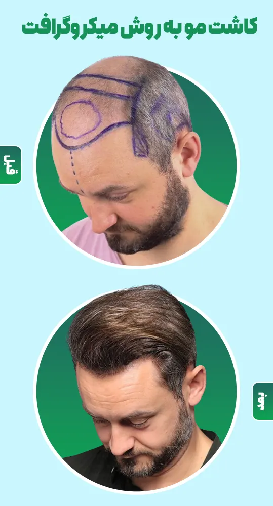 قبل و بعد کاشت مو