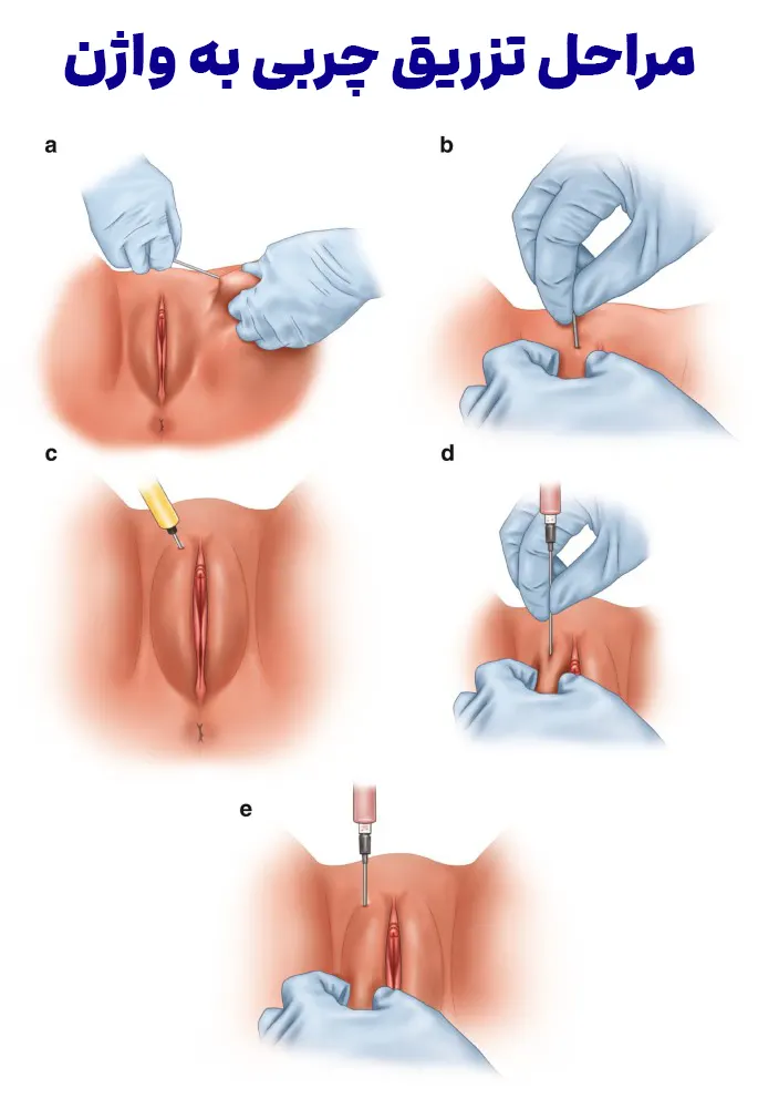 مراحل تزریق چربی به واژن