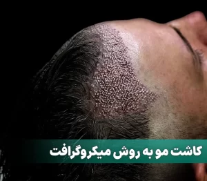 کاشت مو به روش میکروگرافت