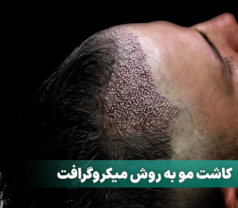 کاشت مو به روش میکروگرافت