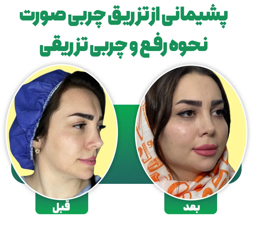 پشیمانی از تزریق چربی