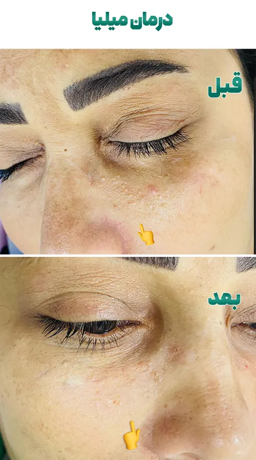 قبل و بعد درمان میلیا