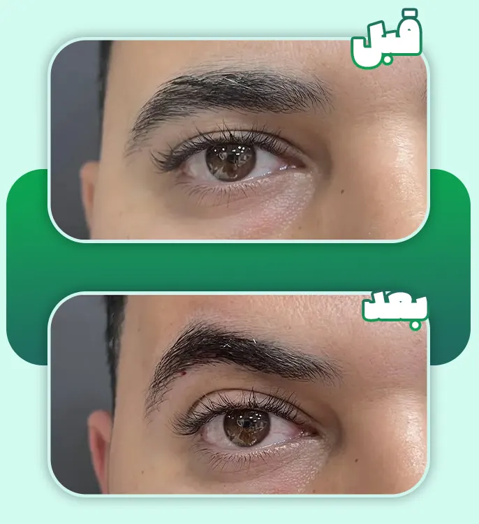 قبل و بعد لیفت ابرو با نخ