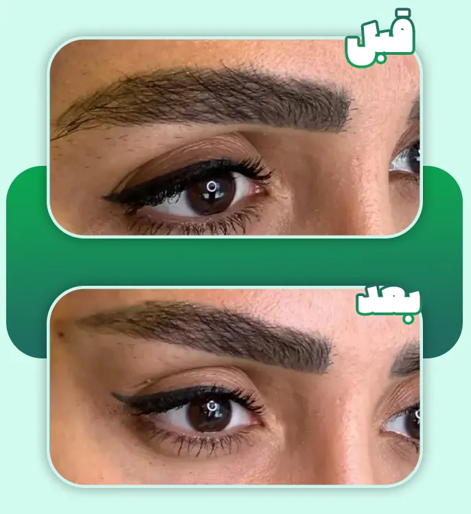 قبل و بعد لیفت ابرو با نخ