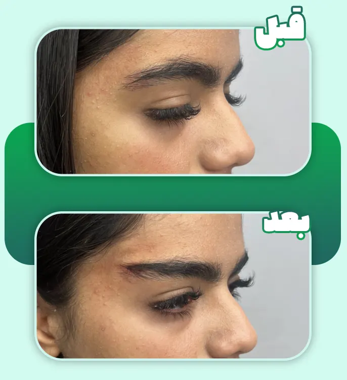 قبل و بعد لیفت ابرو با نخ