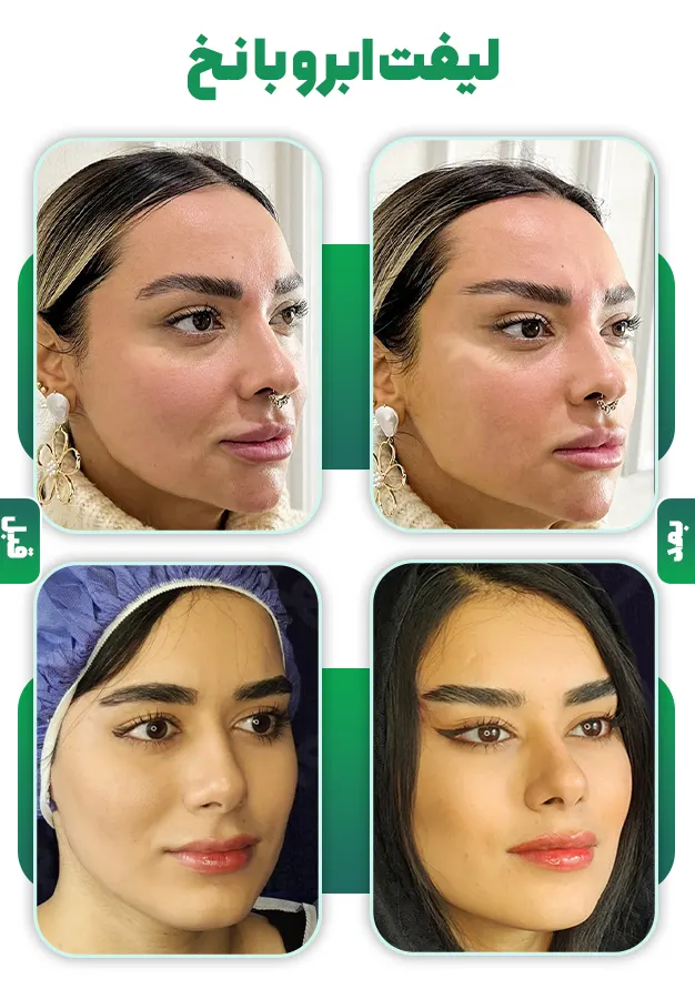 قبل و بعد لیفت ابرو با نخ