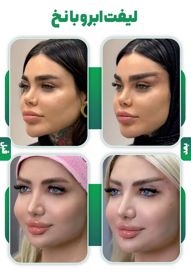 قبل و بعد لیفت ابرو با نخ