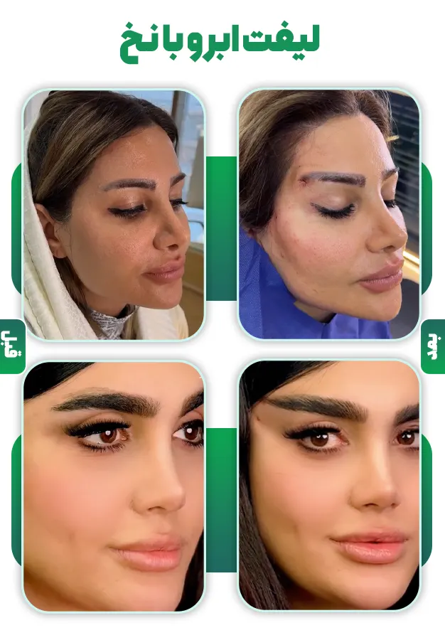 قبل و بعد لیفت ابرو با نخ
