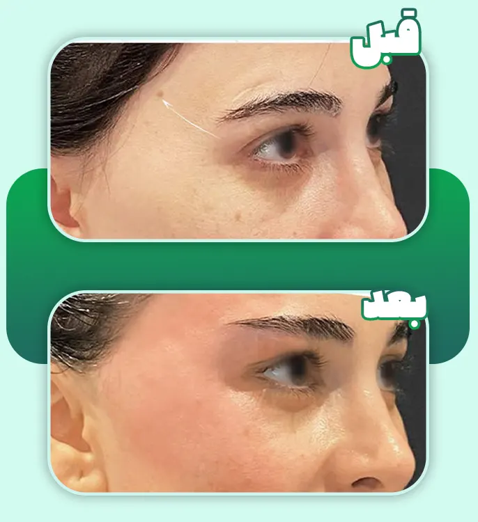 قبل و بعد لیفت ابرو با نخ