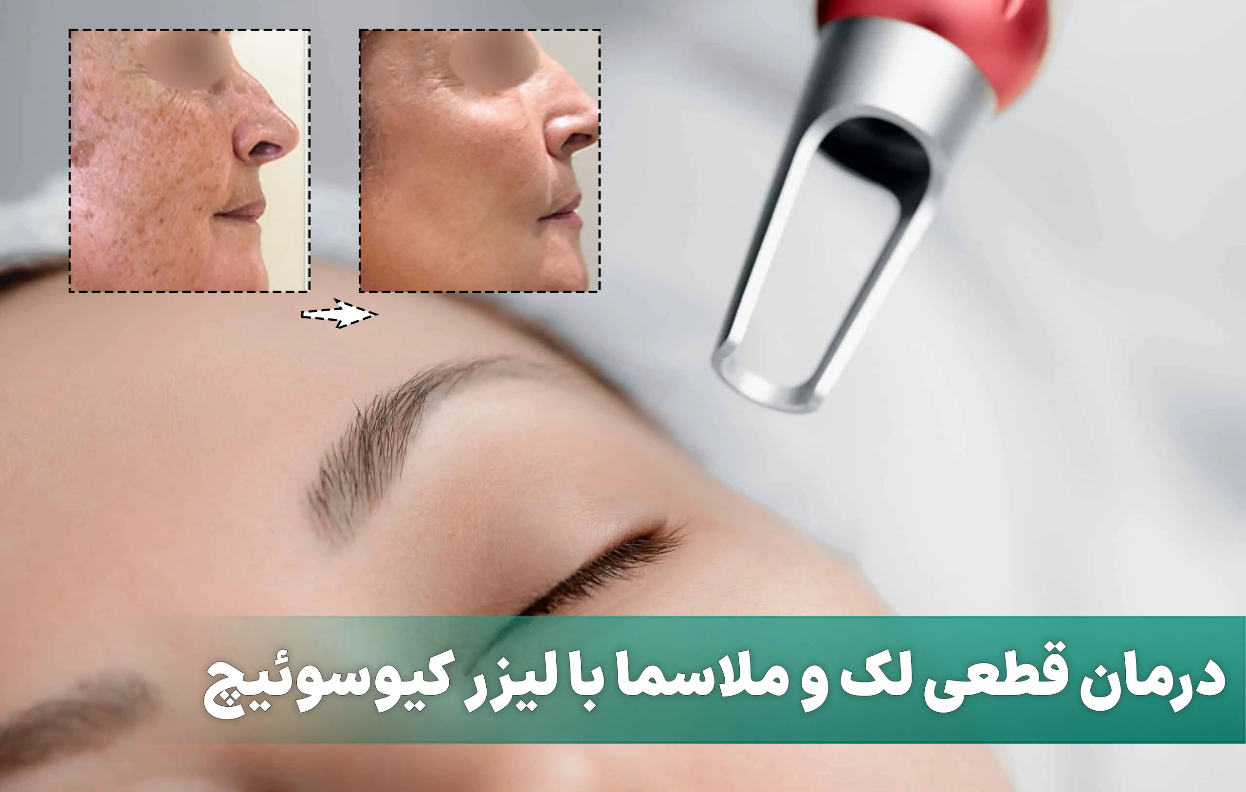 درمان قطعی لک و ملاسما با لیزر کیوسوئیچ