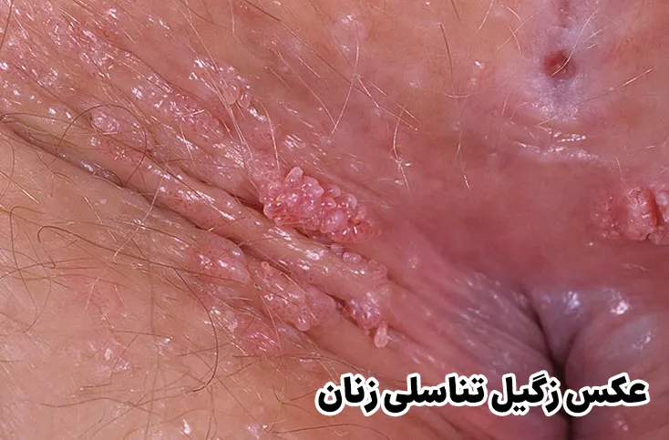 عکس زگیل تناسلی زنان