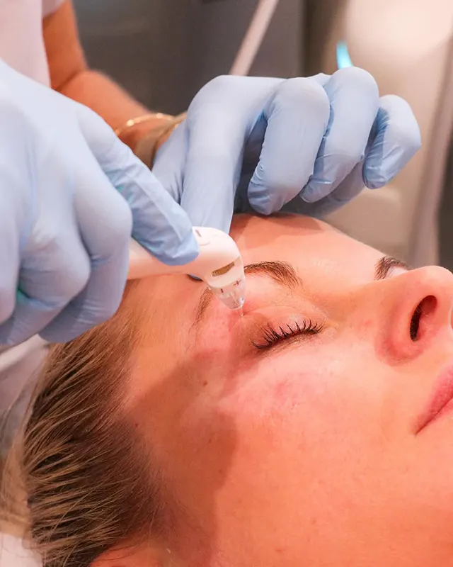 درمان پف زیر چشم با آر اف فرکشنال