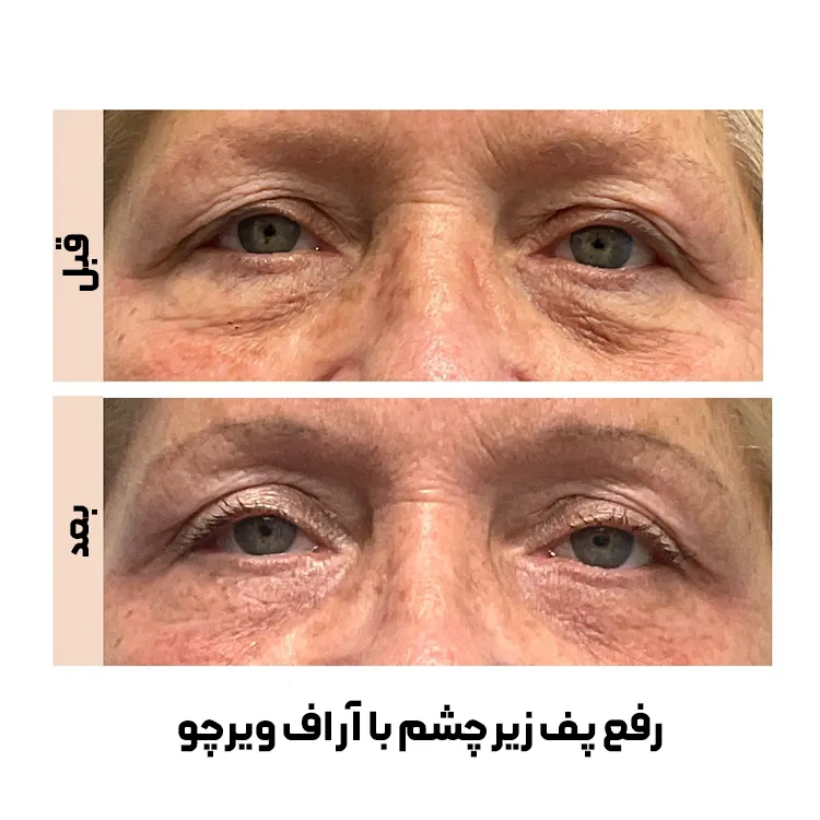 درمان پف زیر چشم با آر اف فرکشنال