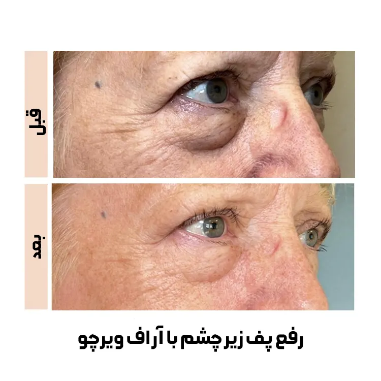 درمان پف زیر چشم با آر اف فرکشنال