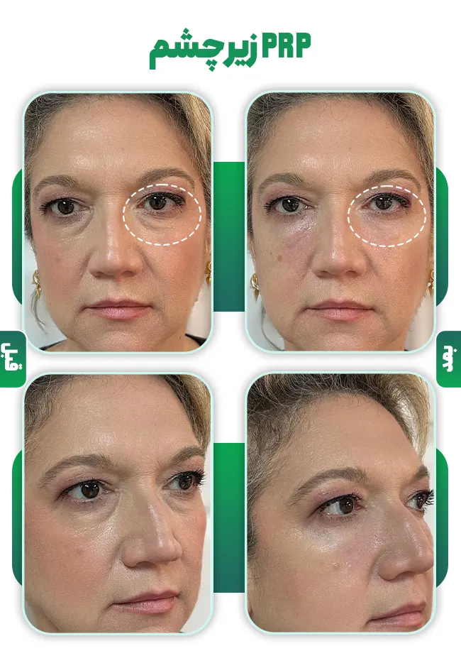 پی آر پی زیر چشم