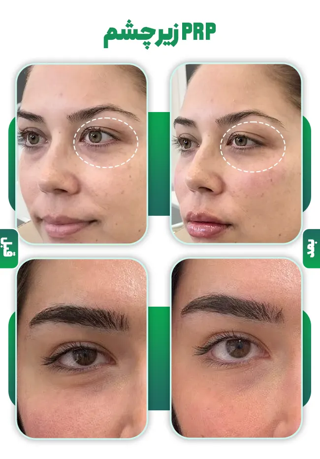 پی آر پی زیر چشم