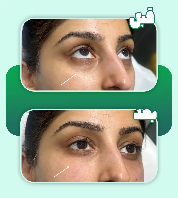 پی آر پی زیر چشم