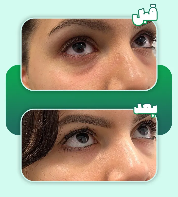 پی آر پی زیر چشم