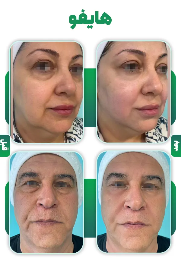 قبل و بعد هایفو
