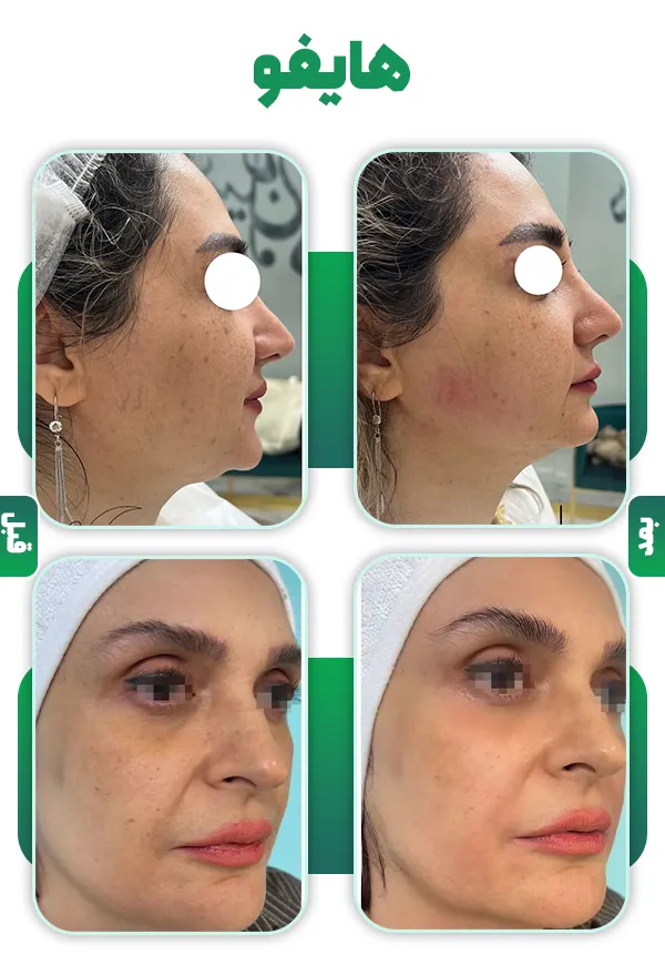 قبل و بعد هایفو